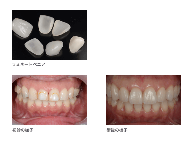 ラミネートベニア症例