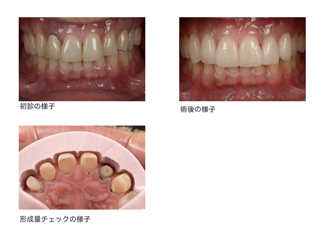 ラミネートベニア症例