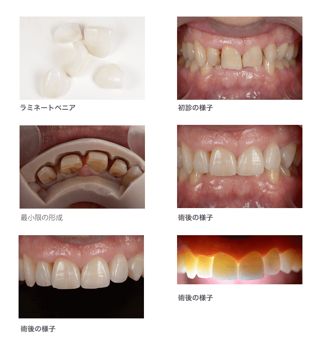 ラミネートベニア症例