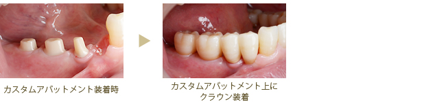 アバットメント