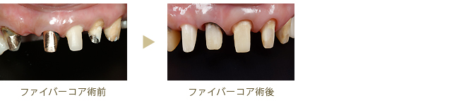 ファイバーコア