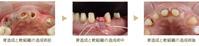 骨造成