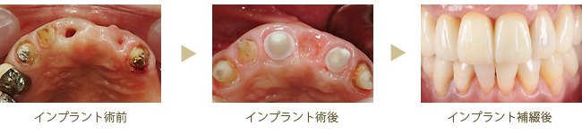 インプラントの症例