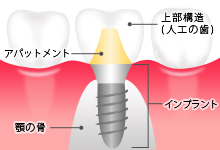 インプラントとは