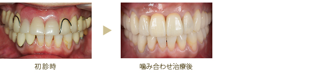噛み合わせ症例1