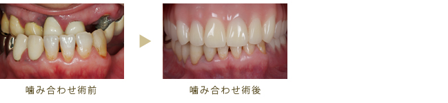 噛み合わせ症例2