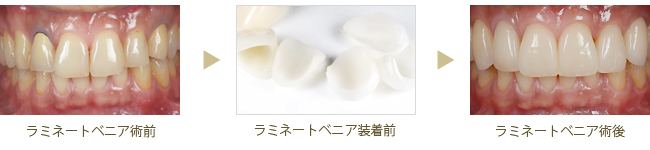 ラミネートべニア