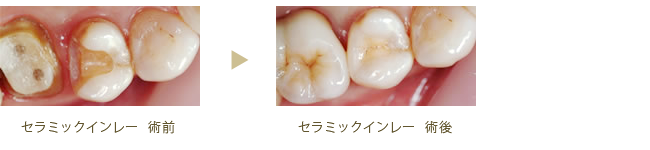 セラミックインレー