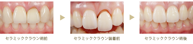 セラミッククラウン
