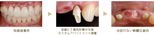 仮歯の装着