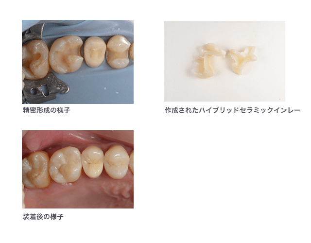 ハイブリットセラミック症例