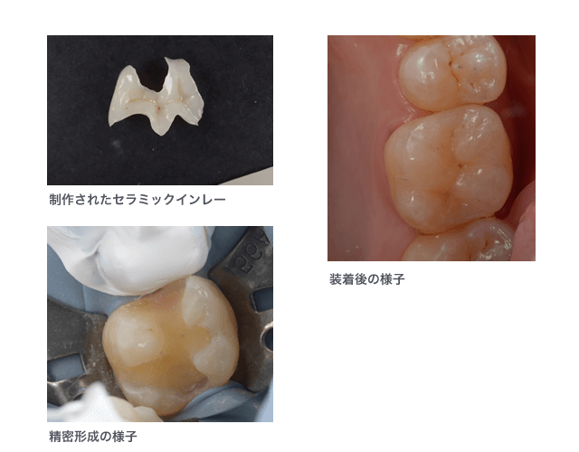 セラミック症例