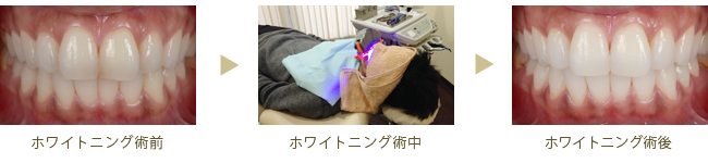 ホワイトニング症例