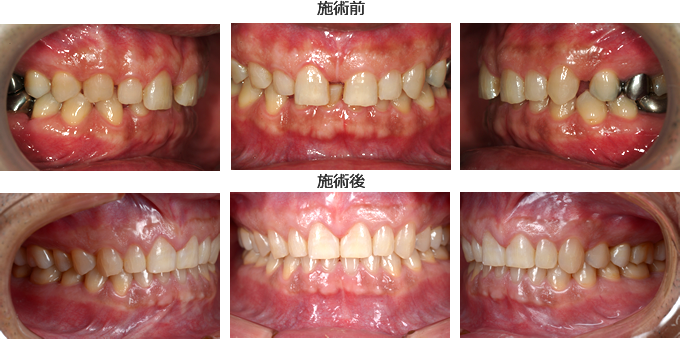 前歯の隙間が気になり 矯正治療を決意 六本木で歯医者歯科をお探しの方は六本木カマエデンタルオフィス